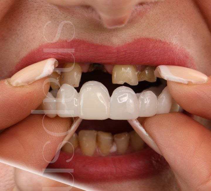 روکش دندان اسنپ اسمایل تایوانی با جایزه 200 تومانی